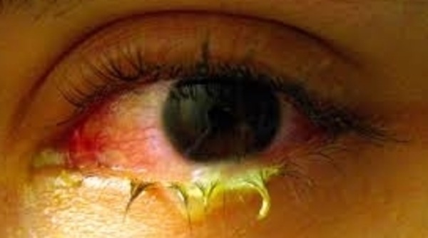 شیوع نوعی ویروس خطرناک چشمی در تهران و شهرستان‌ها